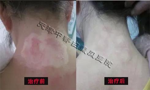 白癜風治療偏方可信嗎？