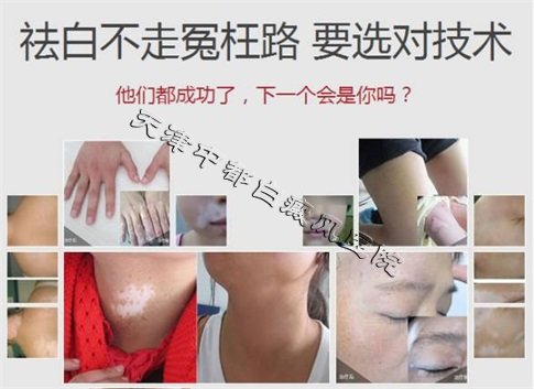治療白癜風的過程中患者應該注意哪些問題?