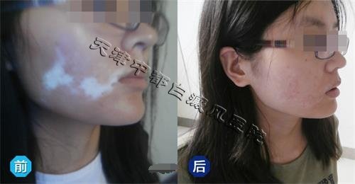 白癜風(fēng)發(fā)作時(shí)如何急救呢?
