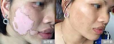 白癜風有效的治療方法是什么呢？