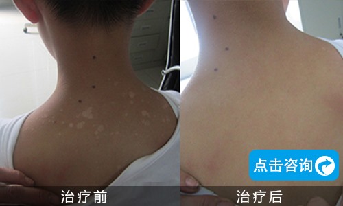 背部白癜風(fēng)